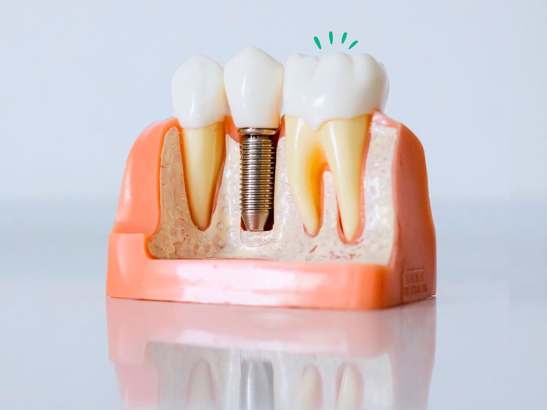 implantodontia-odontologia-clinica