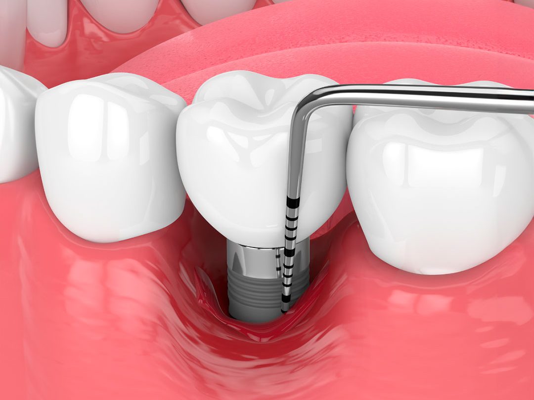 periodontia-odontologia